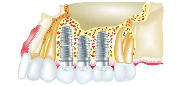 implant_intro4_1.jpg